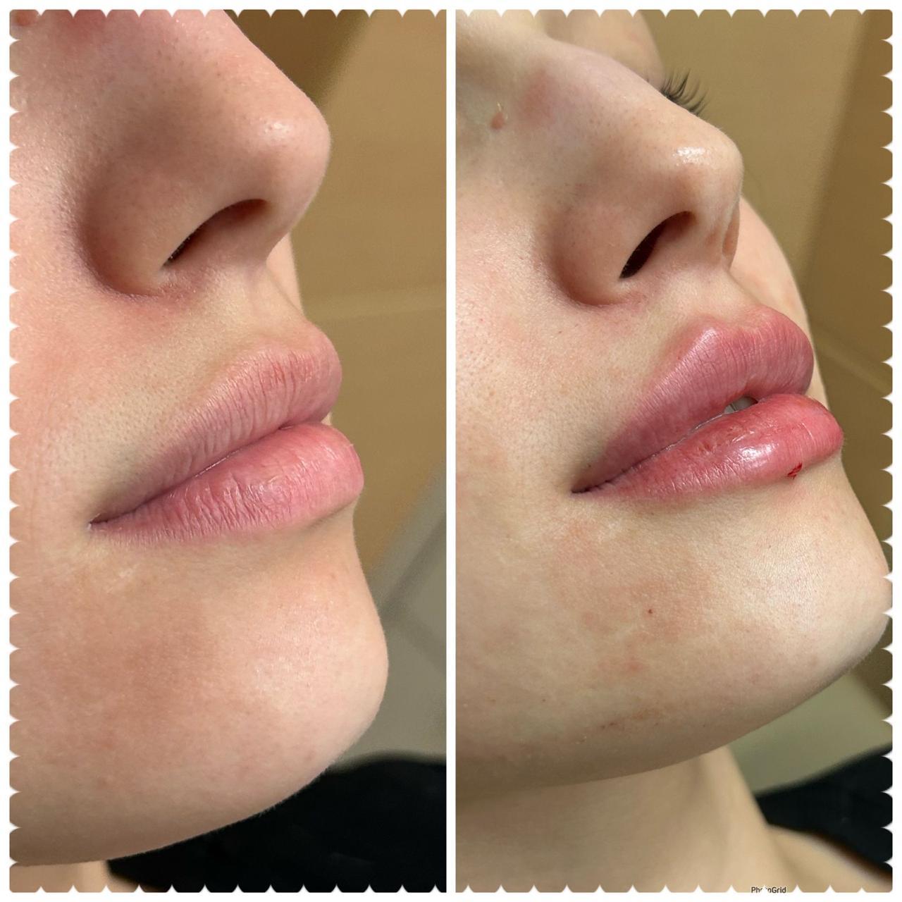 Resultado Preenchimento Labial HD — Lips Design