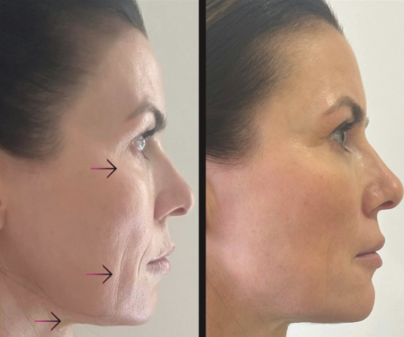Anual de Colágeno + Nano Lift Peptídeos