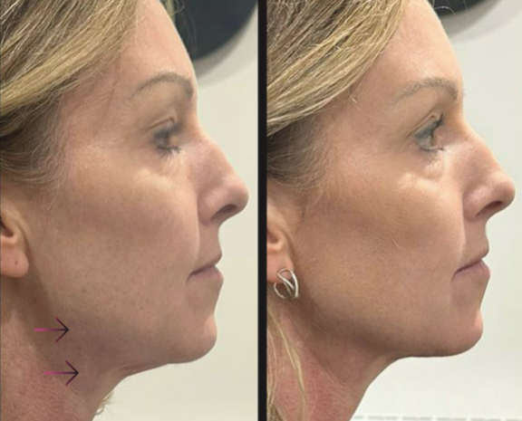 Biolift Peptídeo