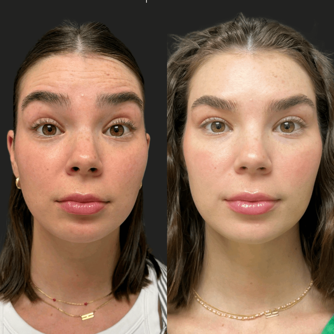 Resultado Toxina Regenerativa