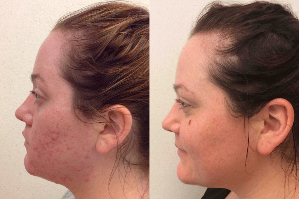 Resultado Tratamento de Acne Ativa
