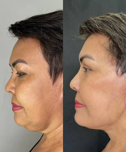 Resultado Lipólise de Papada com Ozônio