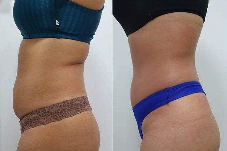 Resultado Programa Lipo Enzimática