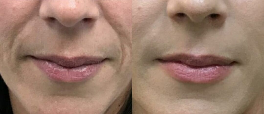 Resultado Harmonização Bigode Chinês