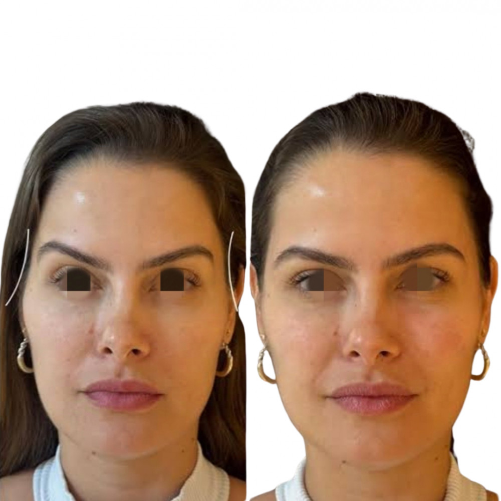 Resultado Preenchimento de Têmporas