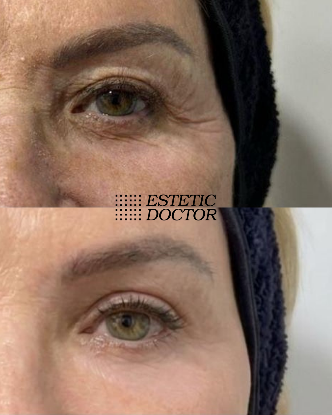 Regeneração de Olhos